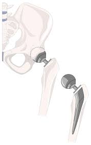 Total Hip Replacement